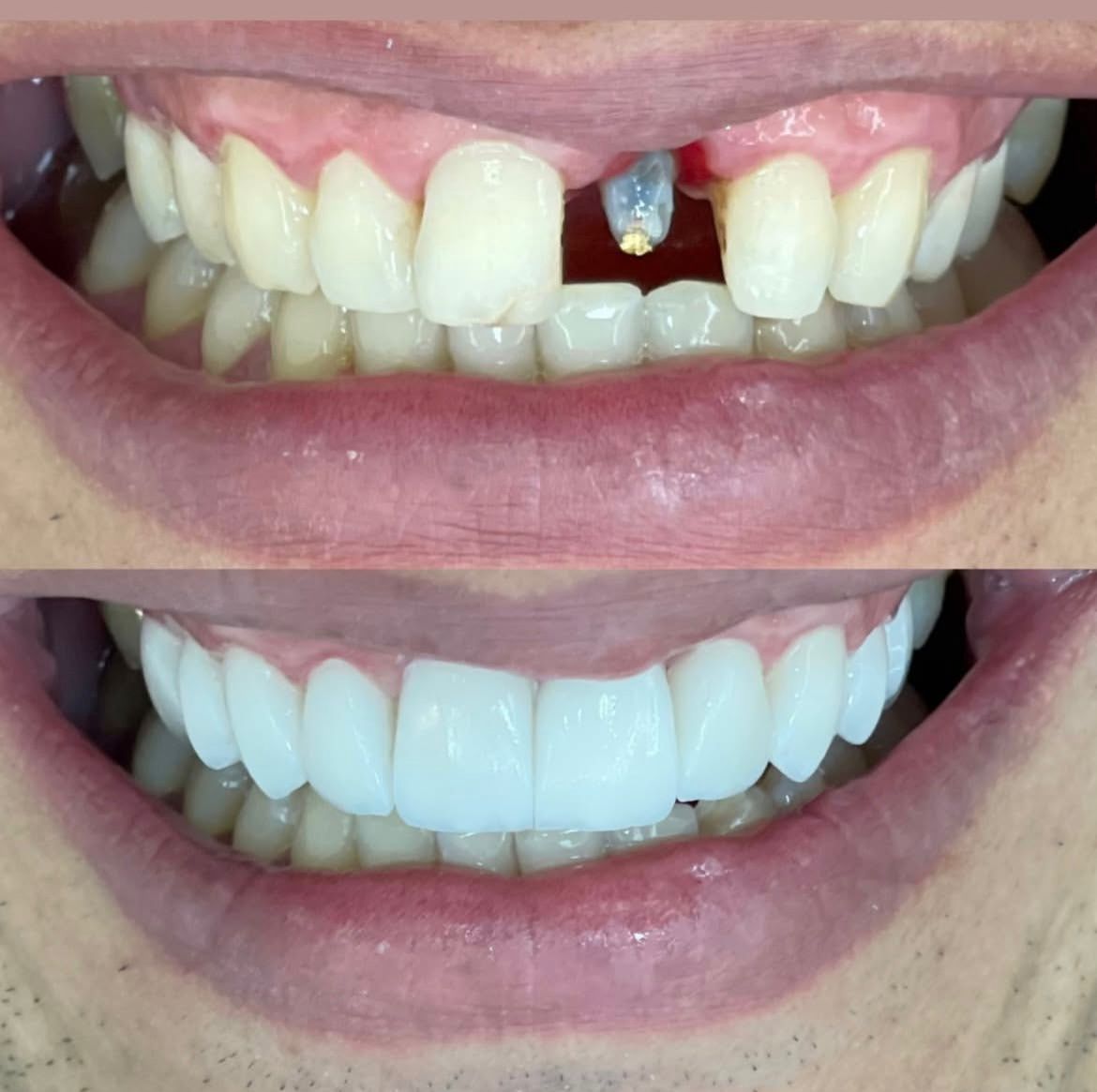 Lentes de contato dental