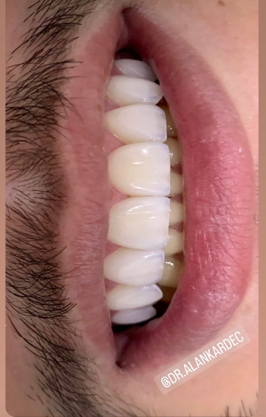 Depois — Restauração