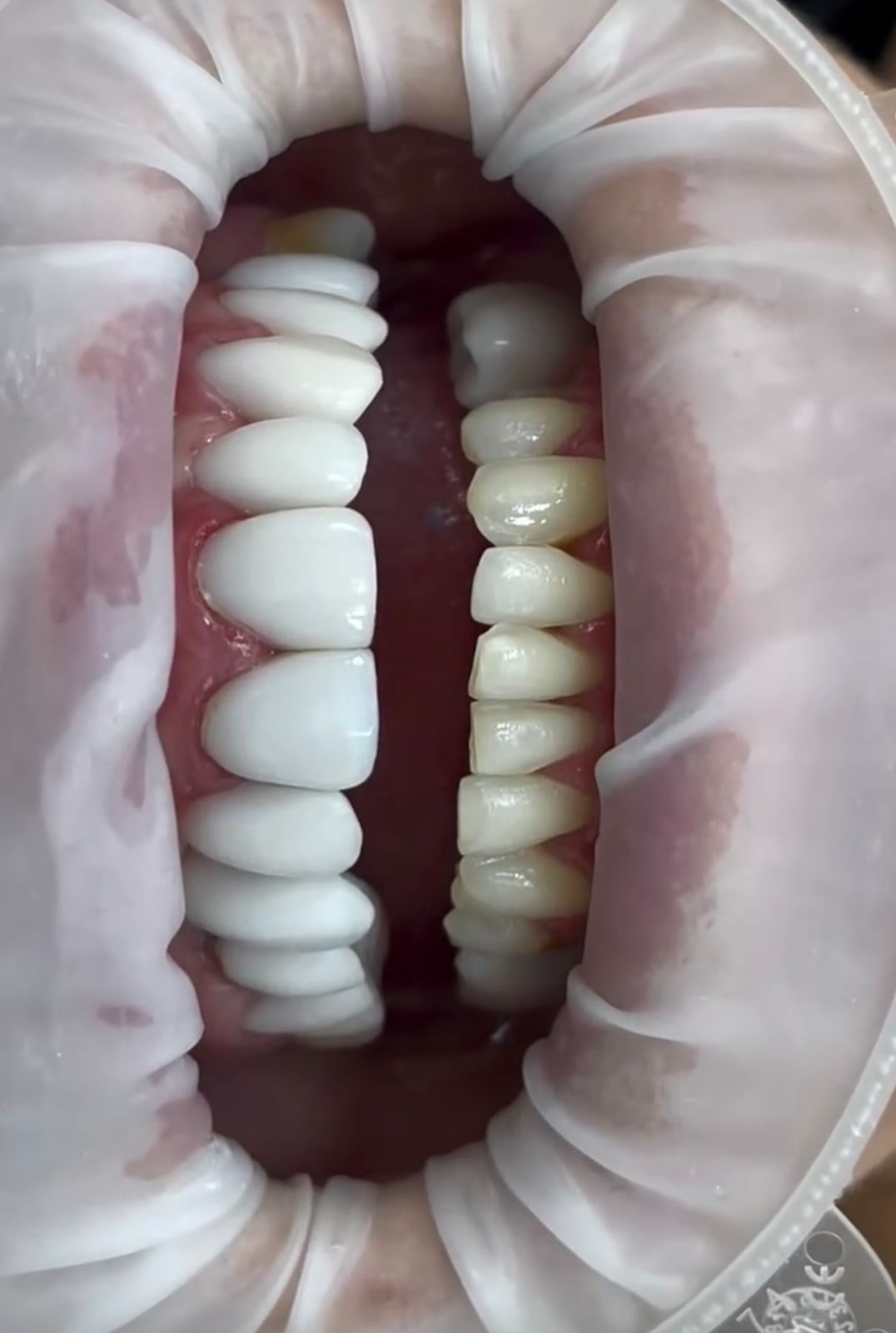 Antes — Restauração