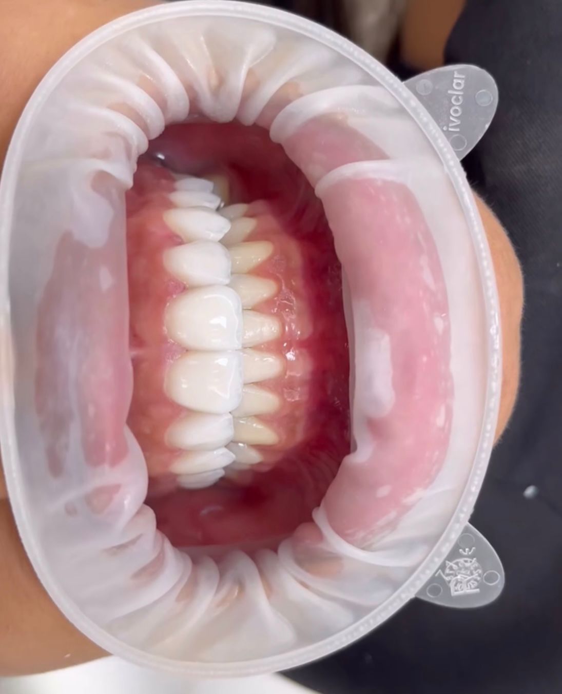 Depois — Aparelho ortodôntico